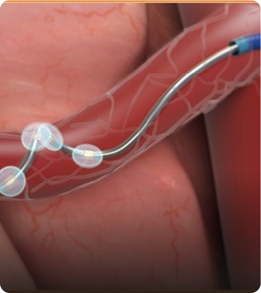 Denervación renal - ACTIVE